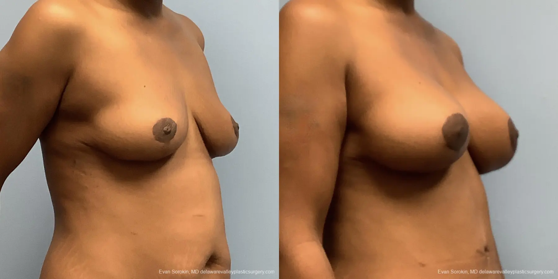 Breast Lift And Augmentation: Patient 45 - Before and After 5