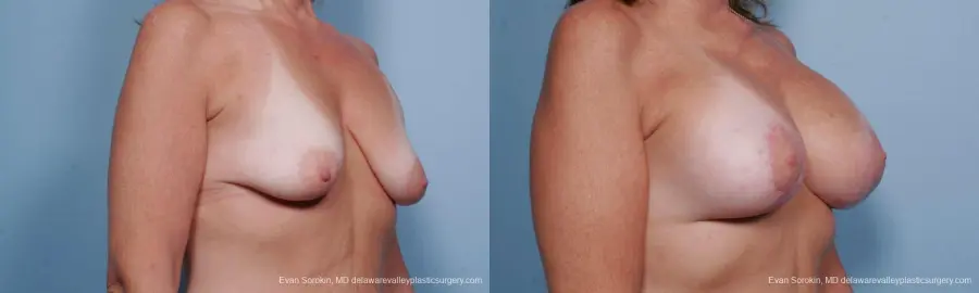 Philadelphia Breast Lift and Augmentation 9438 - Before and After 2