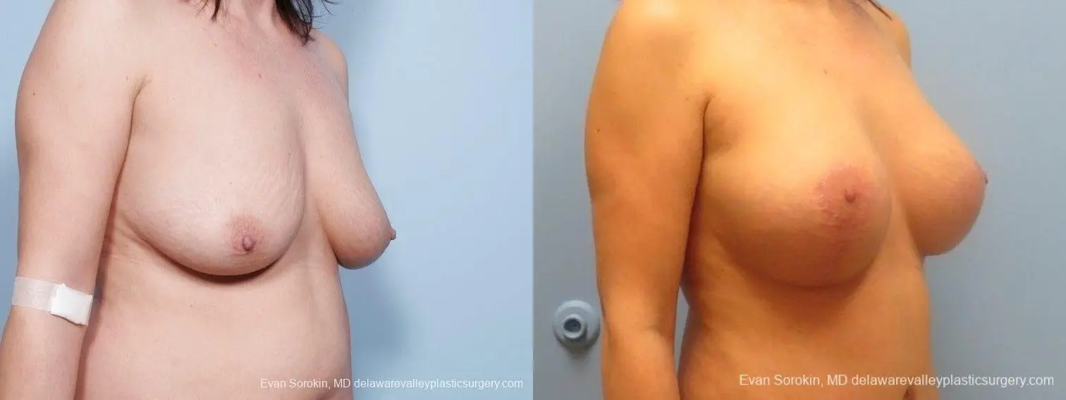 Philadelphia Breast Lift and Augmentation 8671 - Before and After 2