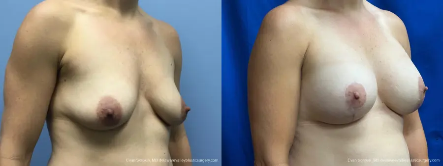 Breast Lift And Augmentation: Patient 48 - Before and After 2