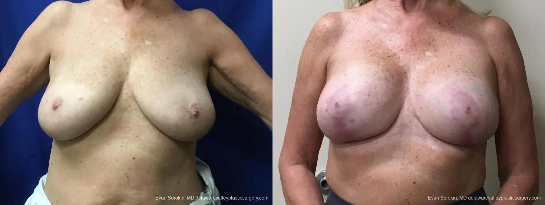 Breast Lift And Augmentation: Patient 49 - Before and After 1