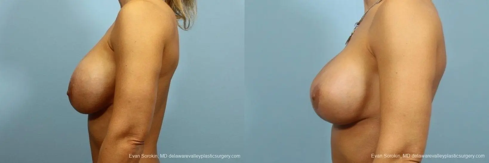 Philadelphia Breast Lift and Augmentation 8710 - Before and After 5