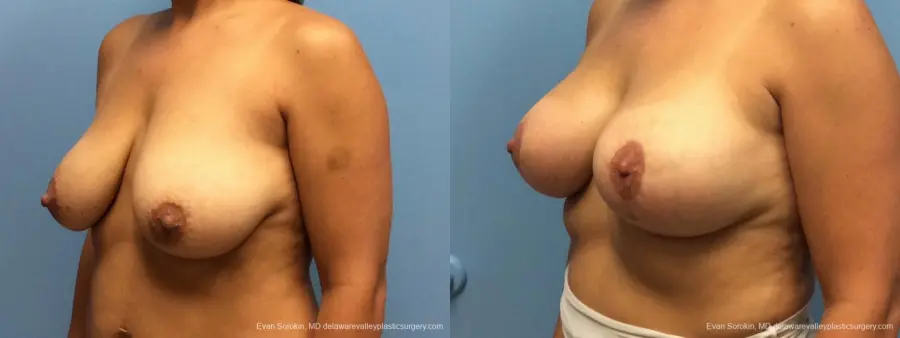Philadelphia Breast Lift and Augmentation 13070 - Before and After 4
