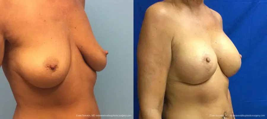 Philadelphia Breast Lift and Augmentation 13068 - Before and After 2