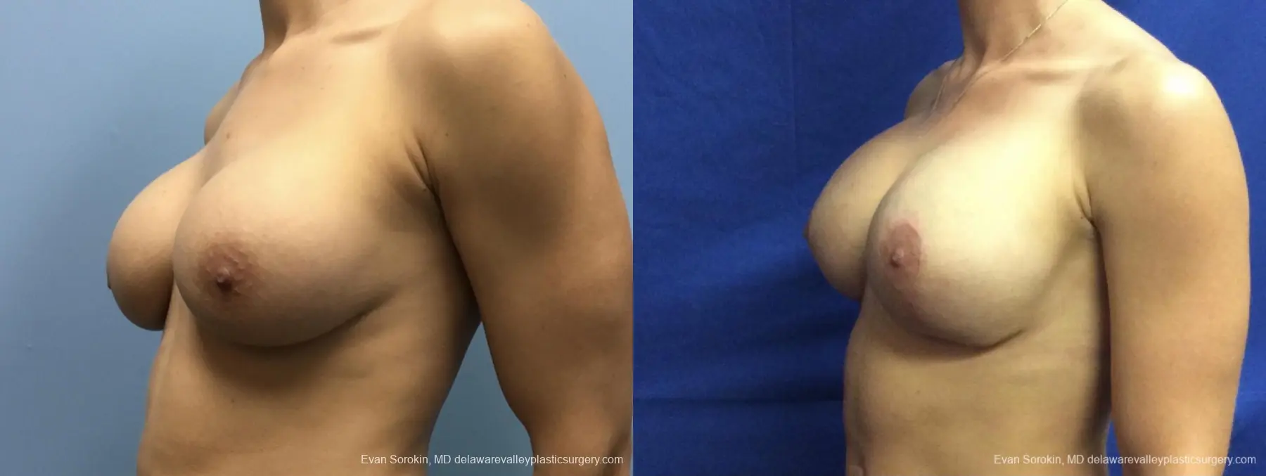 Breast Lift And Augmentation: Patient 42 - Before and After 3