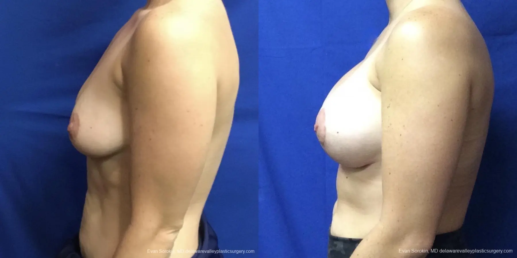Breast Lift And Augmentation: Patient 3 - Before and After 5