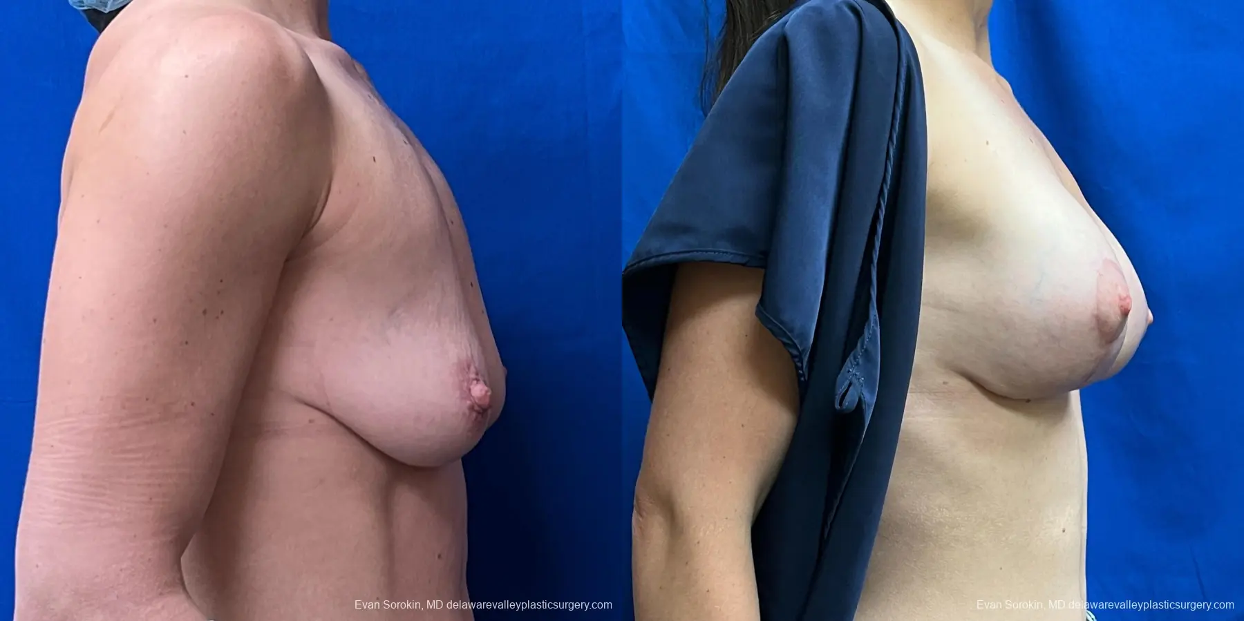 Breast Lift And Augmentation: Patient 46 - Before and After 3