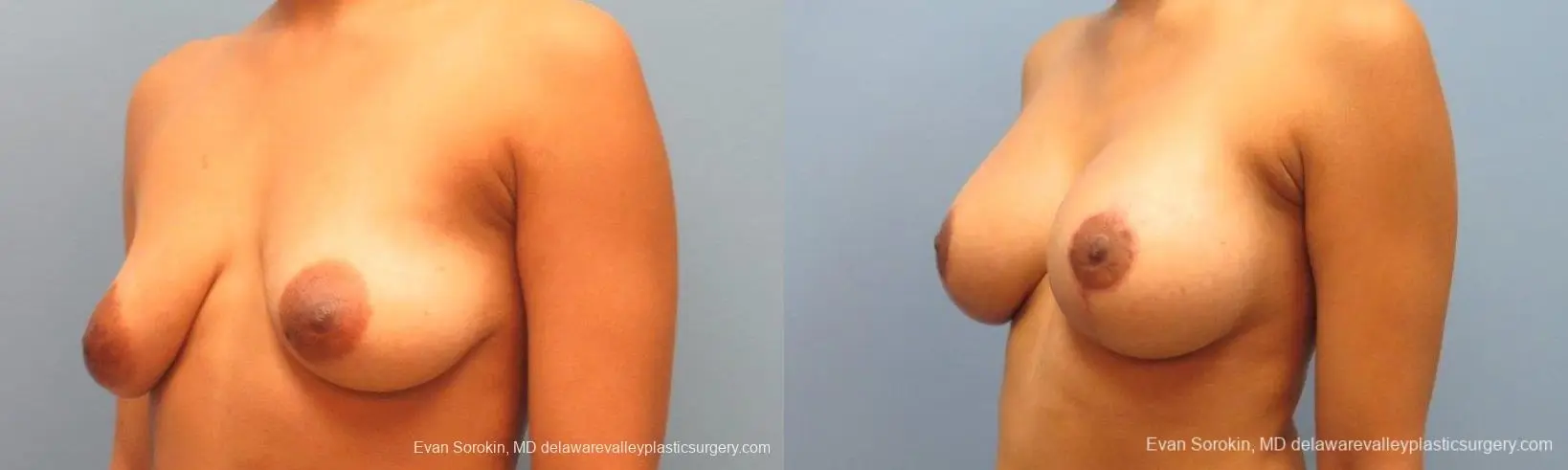 Philadelphia Breast Lift and Augmentation 10119 - Before and After 4