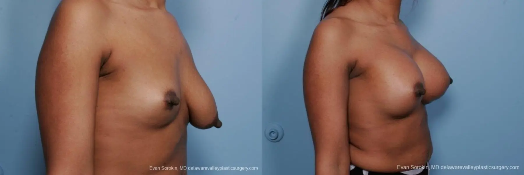 Philadelphia Breast Lift and Augmentation 8689 - Before and After 2