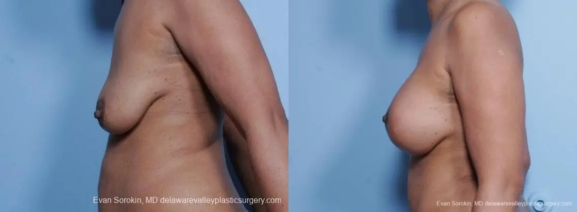 Philadelphia Breast Lift and Augmentation 8692 - Before and After 5