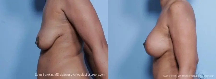 Philadelphia Breast Lift and Augmentation 8692 - Before and After 5