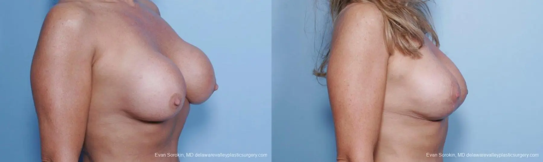 Philadelphia Breast Lift and Augmentation 9453 - Before and After 2