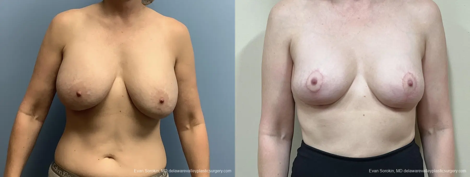 Breast Lift And Augmentation: Patient 50 - Before and After 1