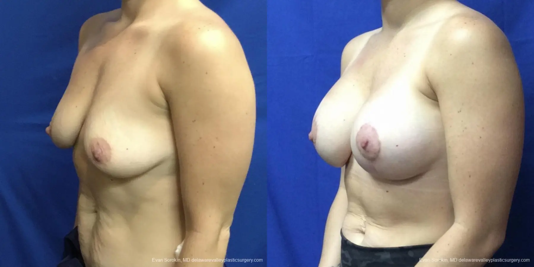 Breast Lift And Augmentation: Patient 3 - Before and After 4