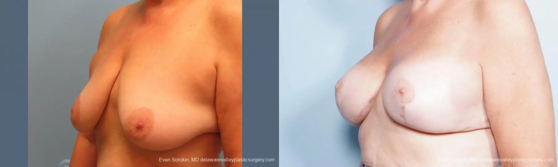 Philadelphia Breast Lift and Augmentation 9431 - Before and After 4