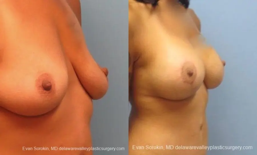 Philadelphia Breast Lift and Augmentation 8824 - Before and After 2