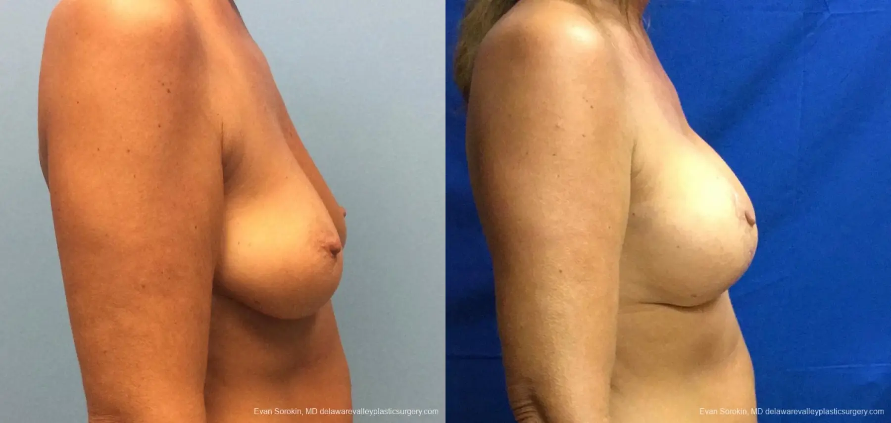 Philadelphia Breast Lift and Augmentation 13068 - Before and After 3