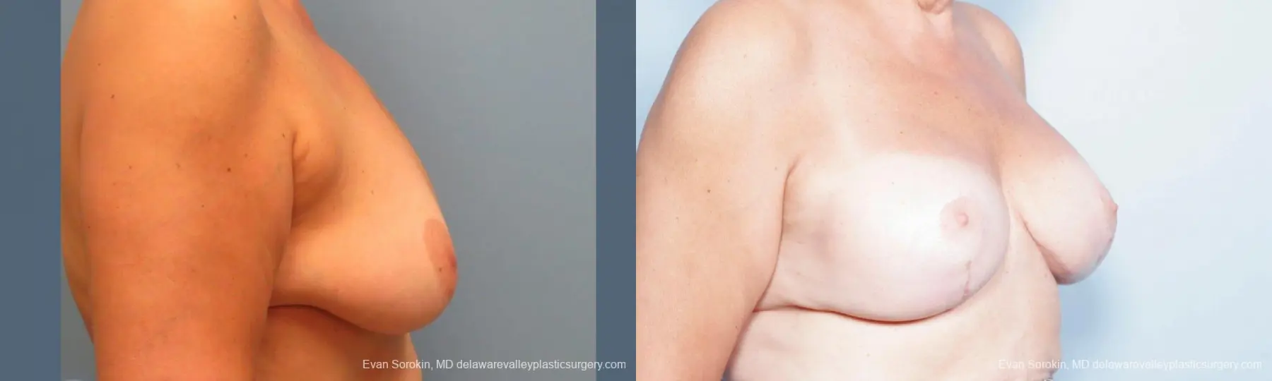 Philadelphia Breast Lift and Augmentation 9431 - Before and After 3