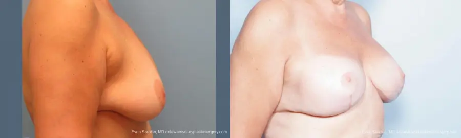 Philadelphia Breast Lift and Augmentation 9431 - Before and After 3