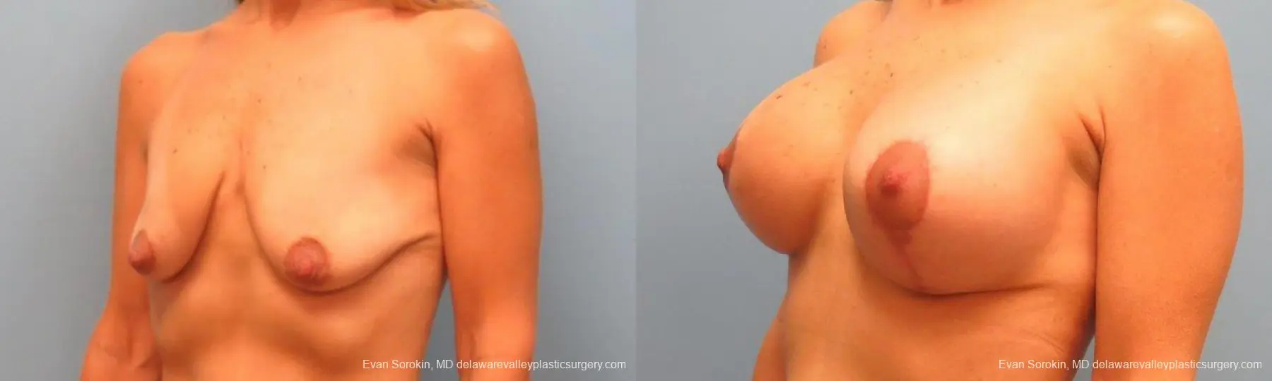 Philadelphia Breast Lift and Augmentation 9485 - Before and After 4