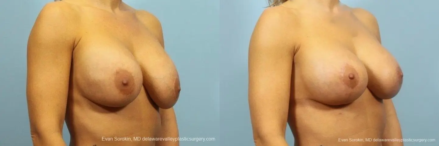 Philadelphia Breast Lift and Augmentation 8710 - Before and After 2