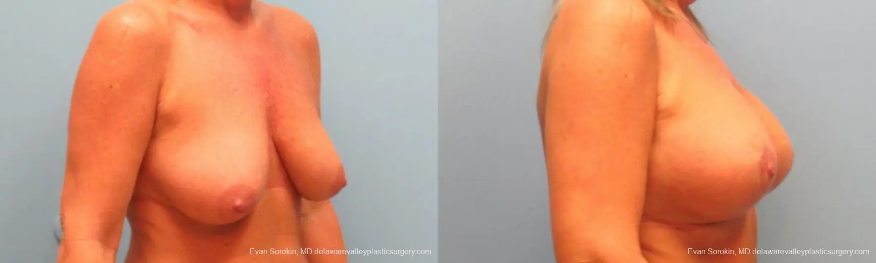 Philadelphia Breast Lift and Augmentation 9398 - Before and After 3