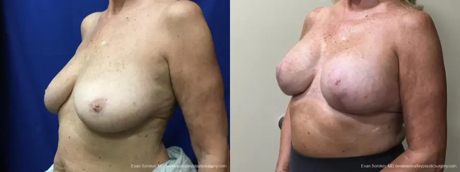 Breast Lift And Augmentation: Patient 49 - Before and After 4