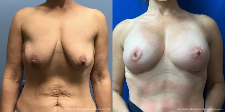 Breast Lift And Augmentation: Patient 47 - Before and After 1