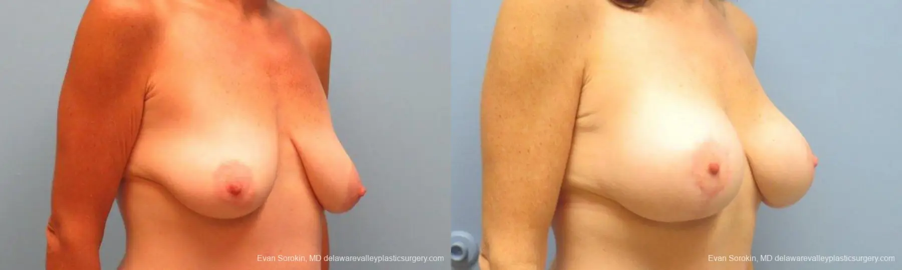 Philadelphia Breast Lift and Augmentation 9486 - Before and After 2