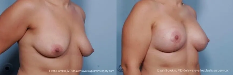 Philadelphia Breast Lift and Augmentation 8702 - Before and After 2