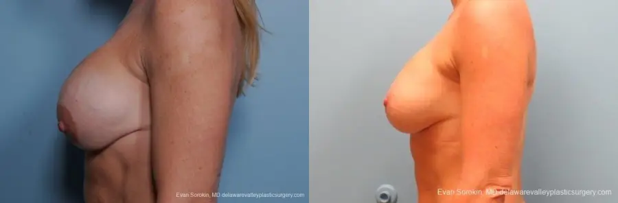 Philadelphia Breast Lift and Augmentation 8690 - Before and After 5