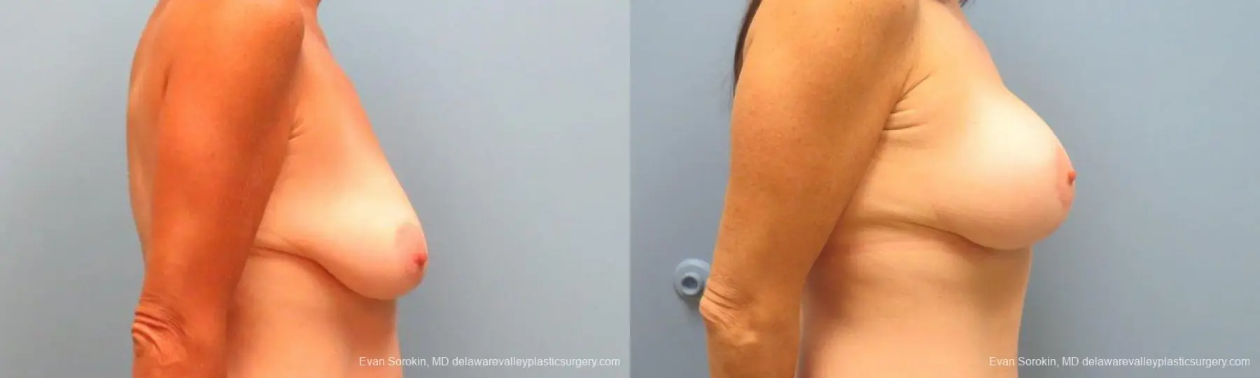 Philadelphia Breast Lift and Augmentation 9486 - Before and After 3