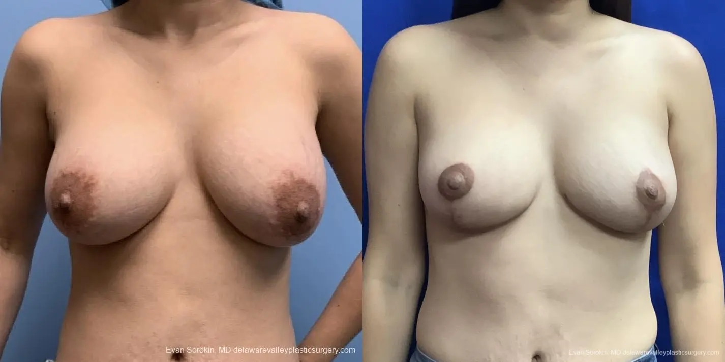 Breast Lift And Augmentation: Patient 44 - Before and After 1