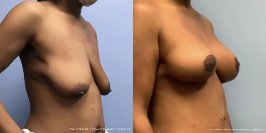 Breast Lift And Augmentation: Patient 45 - Before and After 4