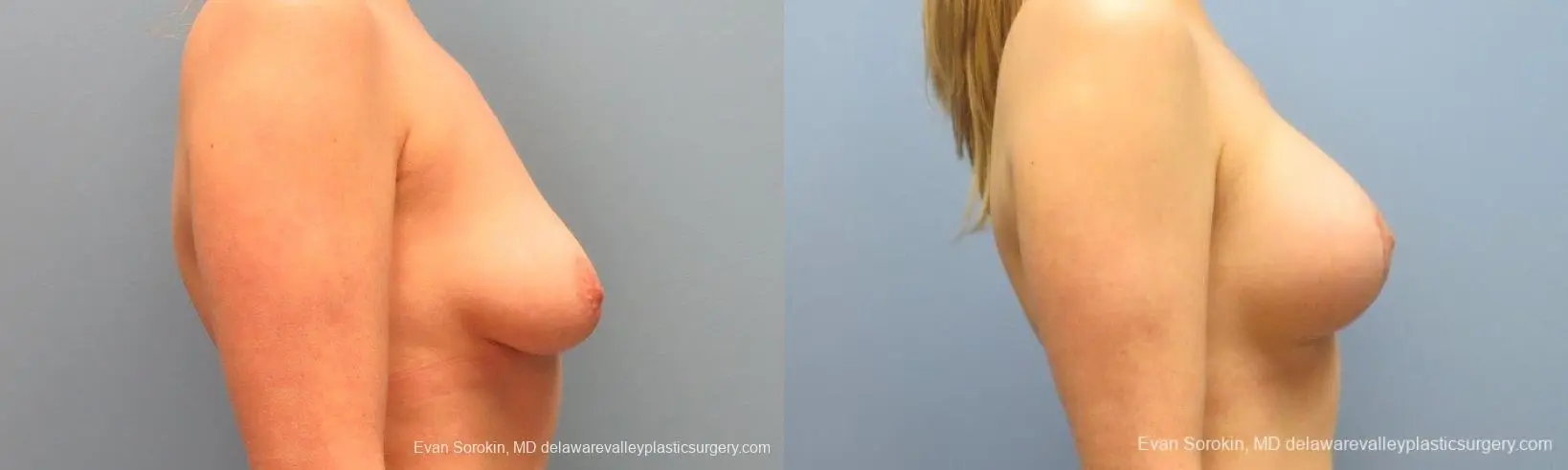 Philadelphia Breast Lift and Augmentation 10116 - Before and After 3