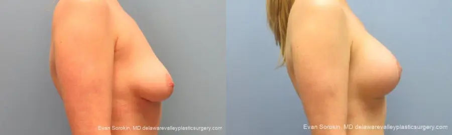 Philadelphia Breast Lift and Augmentation 10116 - Before and After 3