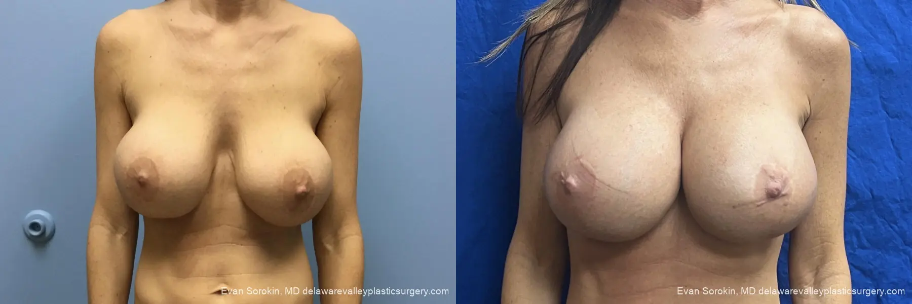 Breast Lift And Augmentation: Patient 58 - Before and After 1