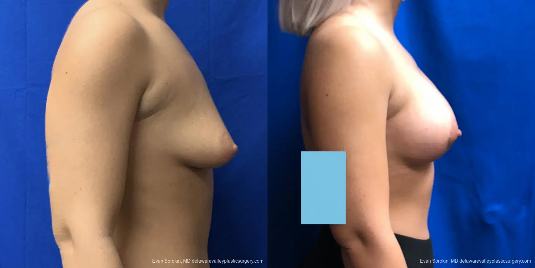 Breast Lift And Augmentation: Patient 43 - Before and After 3