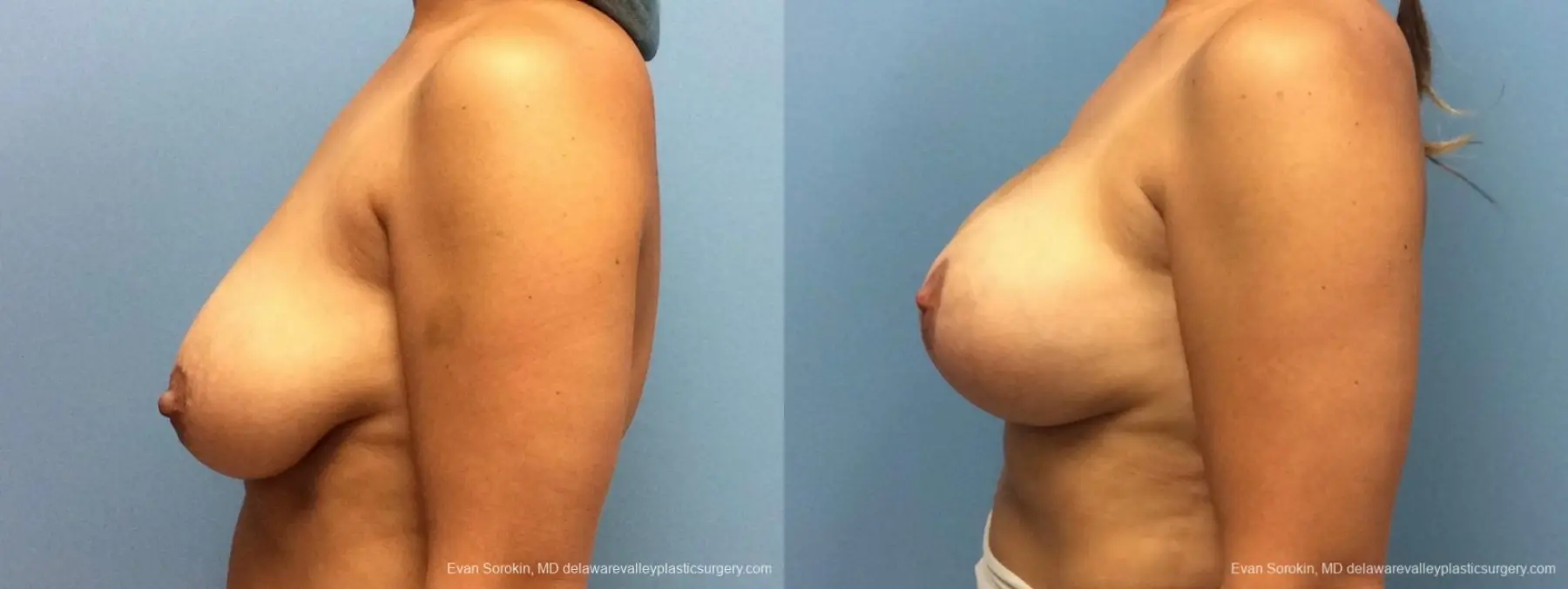 Philadelphia Breast Lift and Augmentation 13070 - Before and After 5