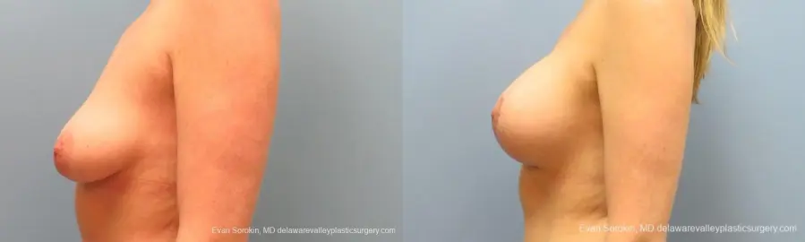 Philadelphia Breast Lift and Augmentation 10116 - Before and After 5