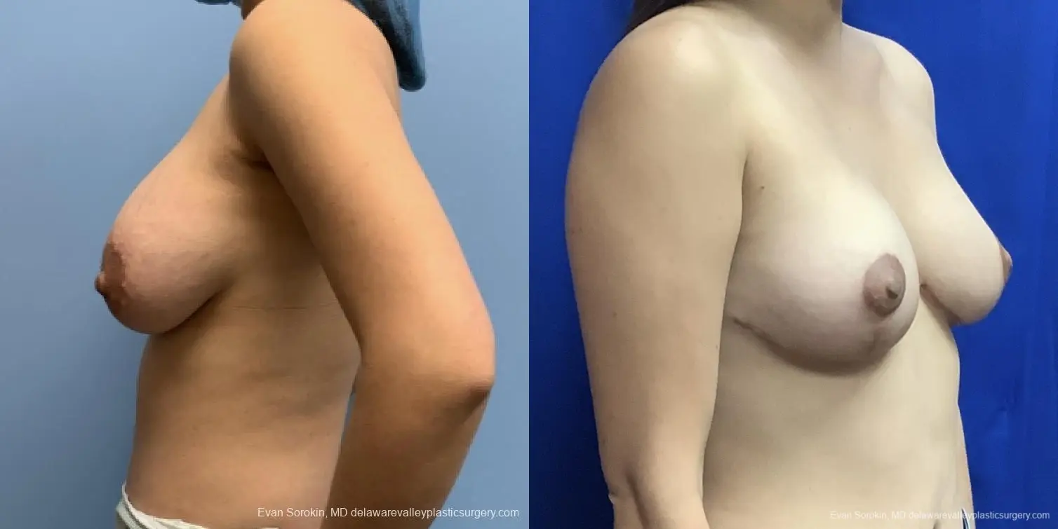 Breast Lift And Augmentation: Patient 44 - Before and After 2