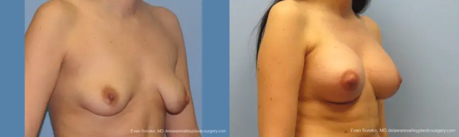 Philadelphia Breast Lift and Augmentation 10115 - Before and After 2