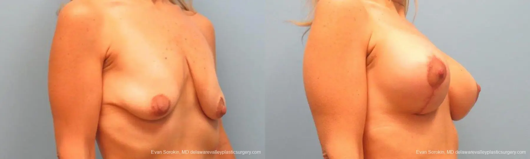 Philadelphia Breast Lift and Augmentation 9485 - Before and After 2
