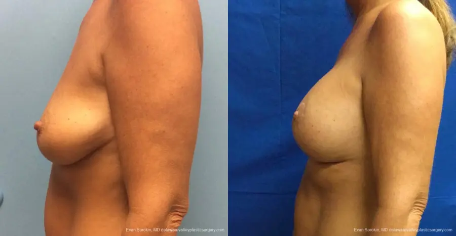Philadelphia Breast Lift and Augmentation 13068 - Before and After 5