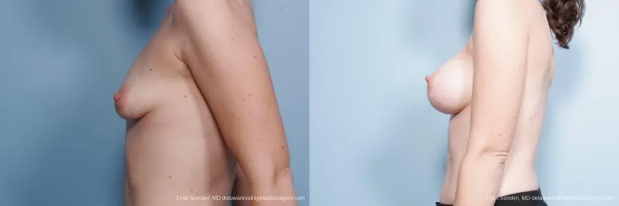 Philadelphia Breast Lift and Augmentation 8686 - Before and After 5