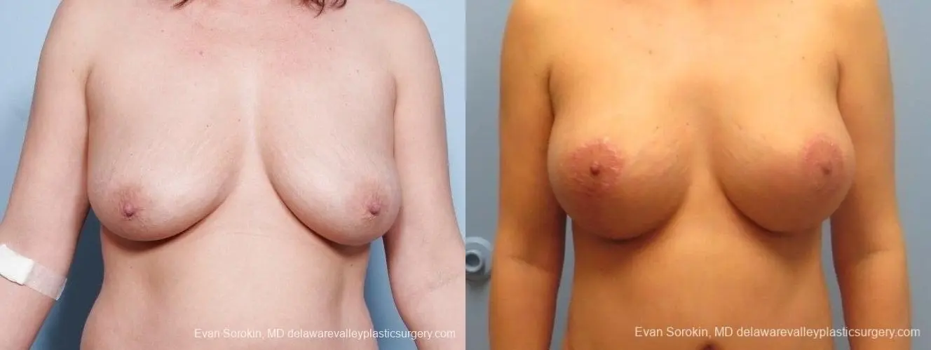 Philadelphia Breast Lift and Augmentation 8671 - Before and After