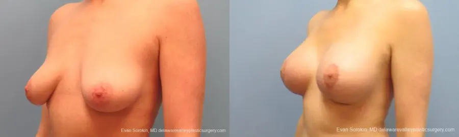 Philadelphia Breast Lift and Augmentation 10116 - Before and After 4