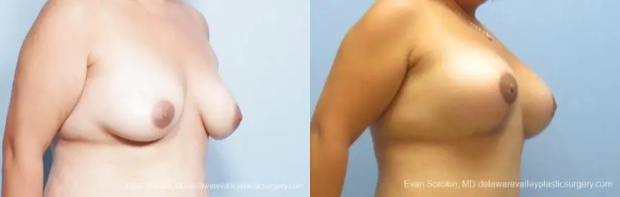 Philadelphia Breast Lift and Augmentation 8677 - Before and After 2