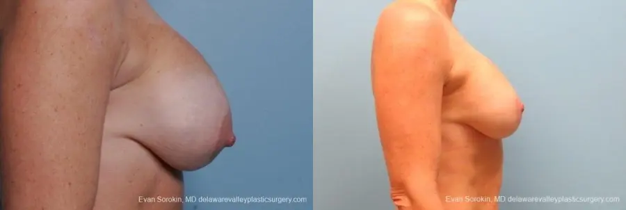 Philadelphia Breast Lift and Augmentation 8690 - Before and After 4