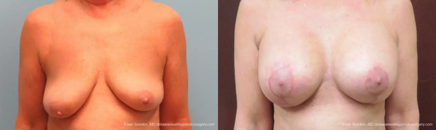 Philadelphia Breast Lift and Augmentation 9598 - Before and After 1